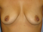 Patient # 12989 Before Photo # 1